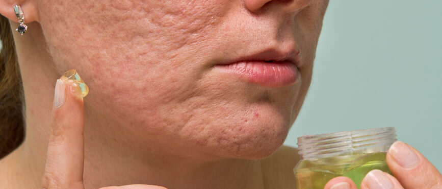 Woman putting Gel on Acne Scars