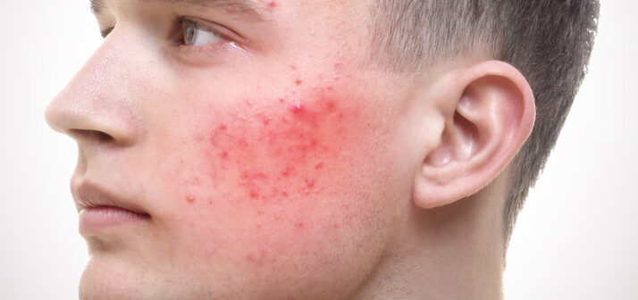 Young Man with Acne on Face