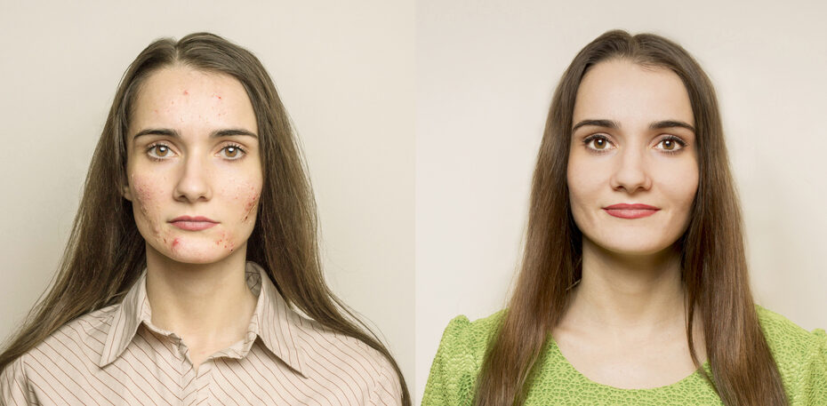 Before and After Shot of Woman with Acne
