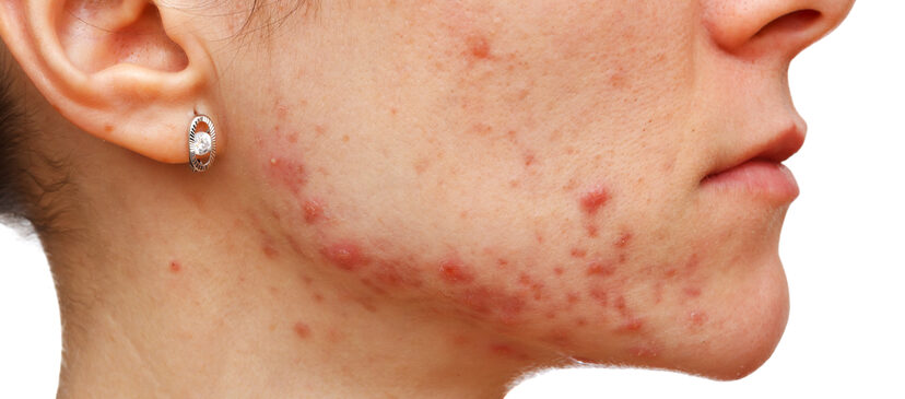 Young Woman with Hormonal Acne on Face