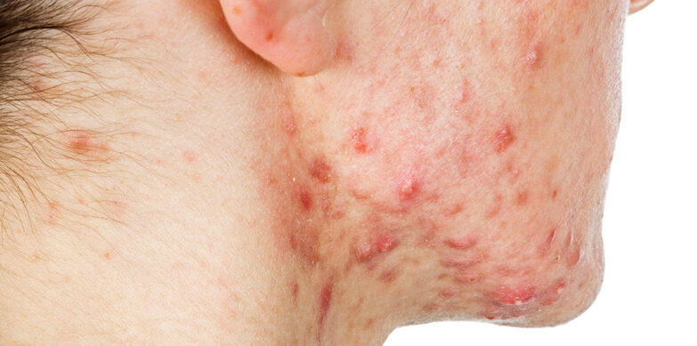 Young Woman with severe Cystic Acne on Face