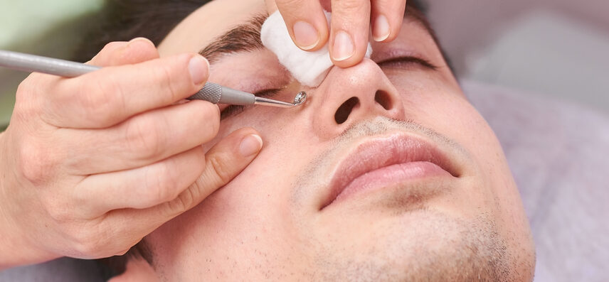 Young man getting Blackheads removed with Extractor
