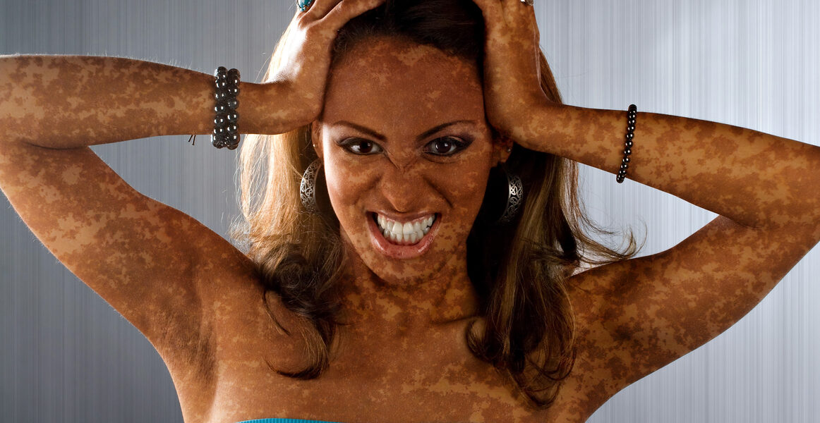 Young Woman with Vitiligo on Face and Arms