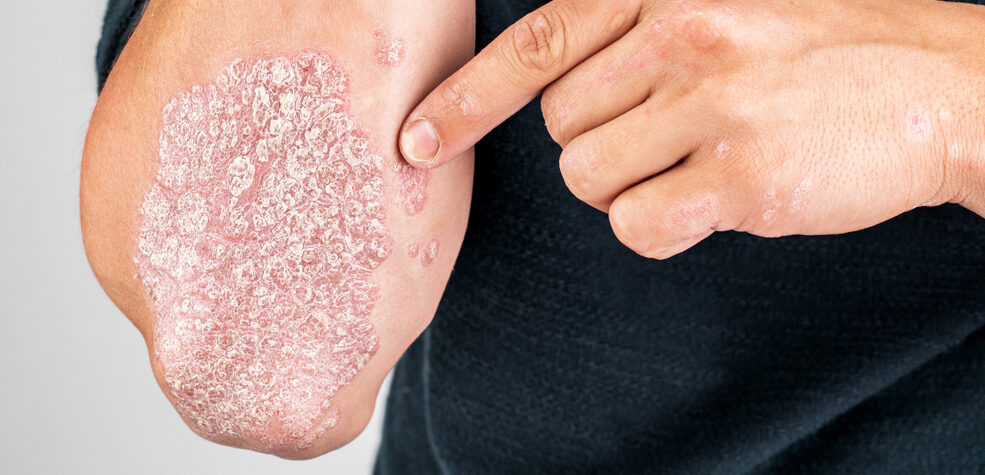 Man with Psoriasis on Elbow and Arm
