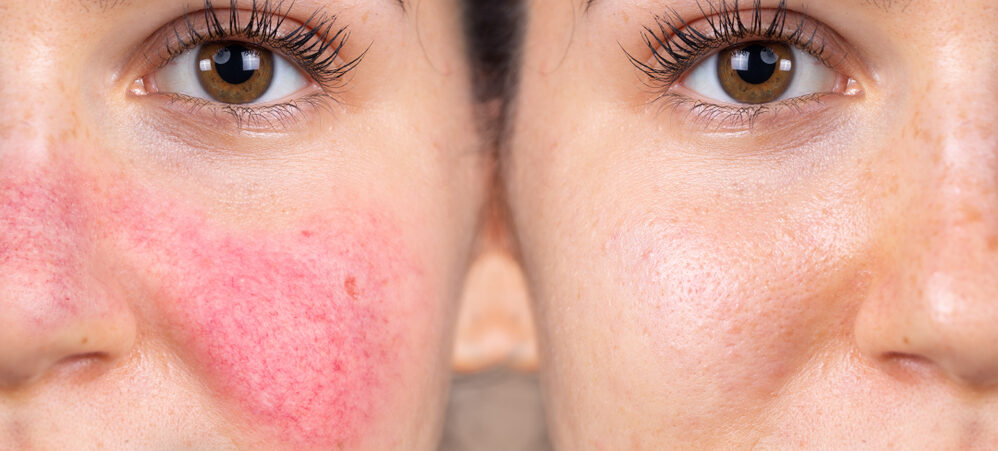 Before and After Shot of Young Woman with Rosacea