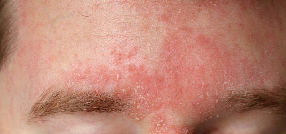 Man with Dermatitis on Forehead