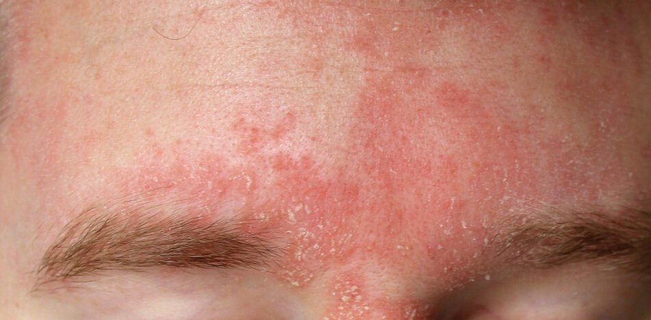 Man with Dermatitis on Forehead