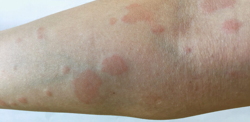 Lupus Skin Rash on Arm with Round Circular Shapes