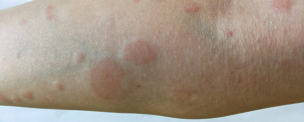 Lupus Skin Rash with Circular Red Shapes